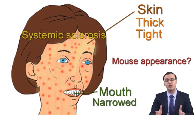  در اين ويدئو در باره اسکلرودرمي (اسکلروز سيستميک) به زبان انگليسي توضيح داده مي شود 